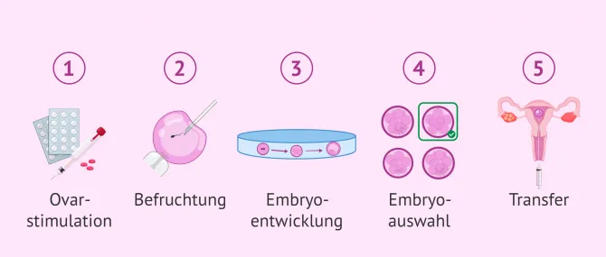 Was sind die wichtigsten Vorteile der In-vitro-Fertilisation?