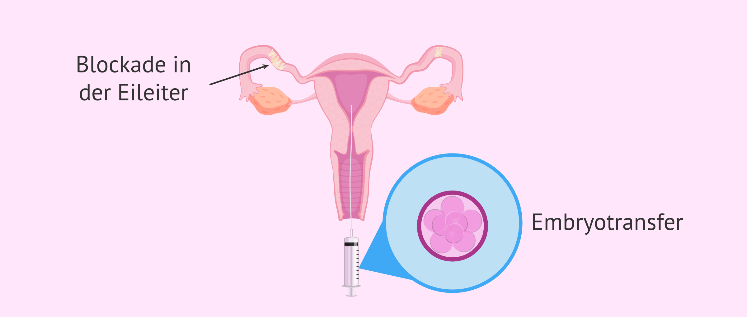 IVF bei blockierter Eileiter