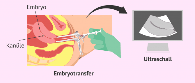Imagen: Ultraschallgesteuerter Embryotransfer