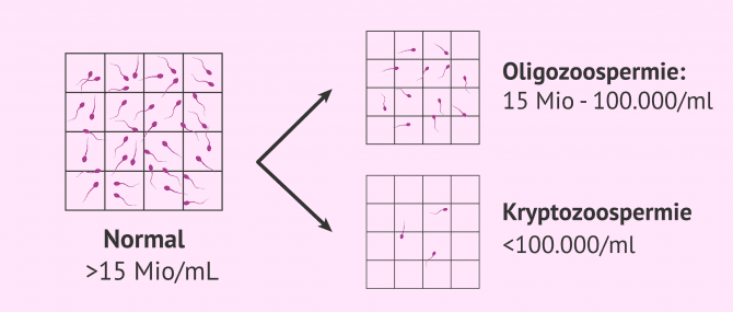 Imagen: Normale, oligozoospermische und kryptozoospermische Samenprobe