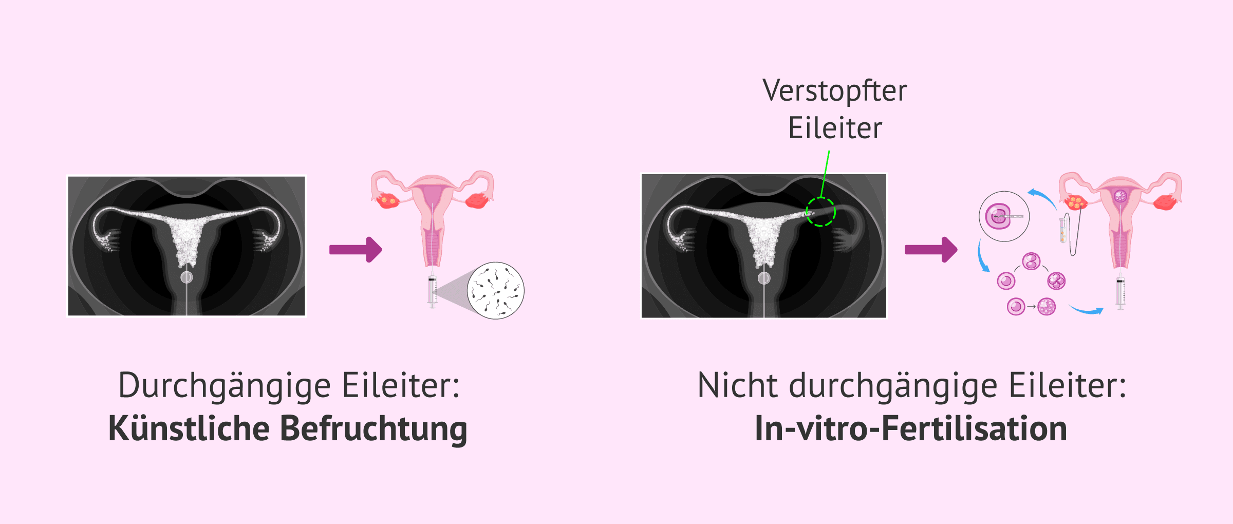 Imagen: Fruchtbarkeitsbehandlung je nach HSG-Ergebnis