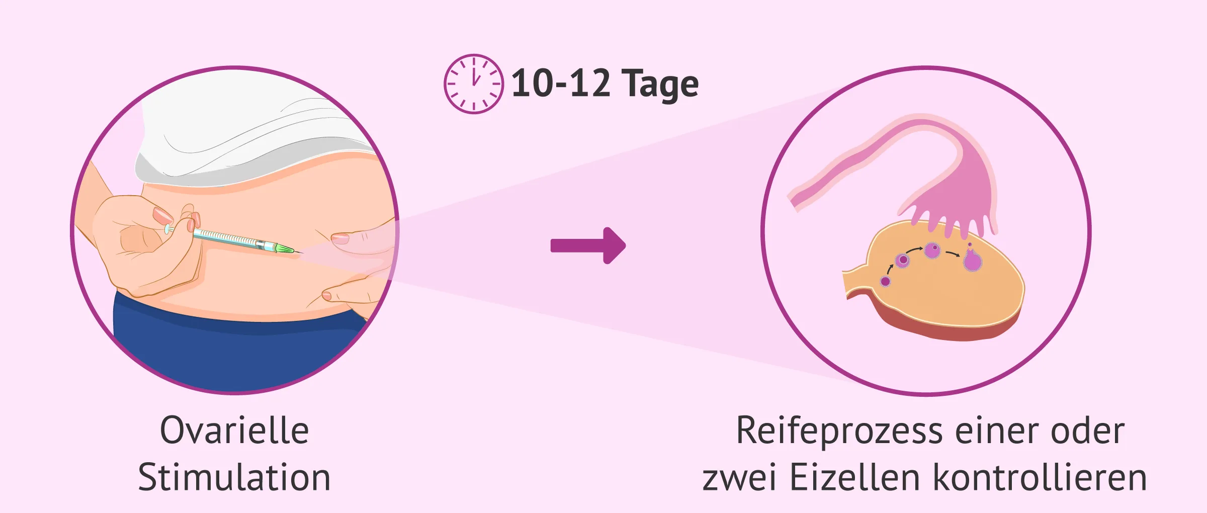Stimulationsbehandlung: das Heranreifen der Eizellen kontrollieren