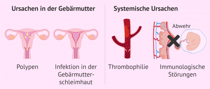 Imagen: Gebärmutterfaktor und systemische Ursachen bei Einnistungsversagen