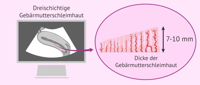 Imagen: Optimaler Zustand der Gebärmutterschleimhaut für die Schwangerschaft