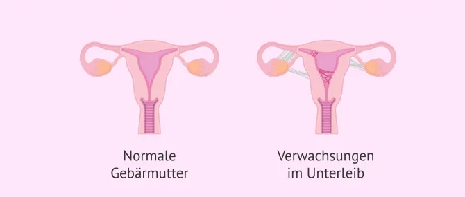 Was sind Verwachsungen im Unterleib?