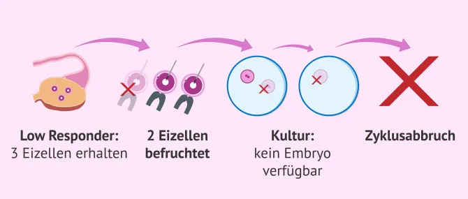 Ab wann gilt man in einer IVF als Low Responder? Ursachen und Lsung