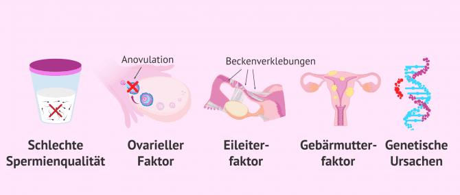 Imagen: Mögliche Ursachen bei primärer Sterilität