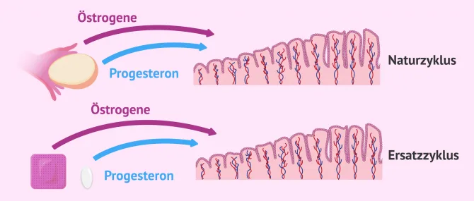Imagen: Gebärmutterschleimhaut für Embryotransfer aufbauen