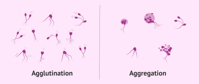 Agglunitation der Spermien: Ursachen, Symptome und Lösungen