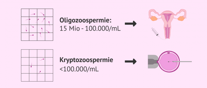 Imagen: Männer mit niedriger Spermienmenge