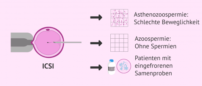 Imagen: ICSI als Lösung bei männlicher Sterilität