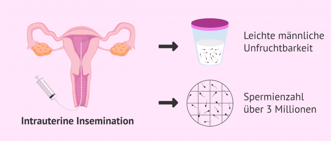 Imagen: IUI bei männlicher Sterilität
