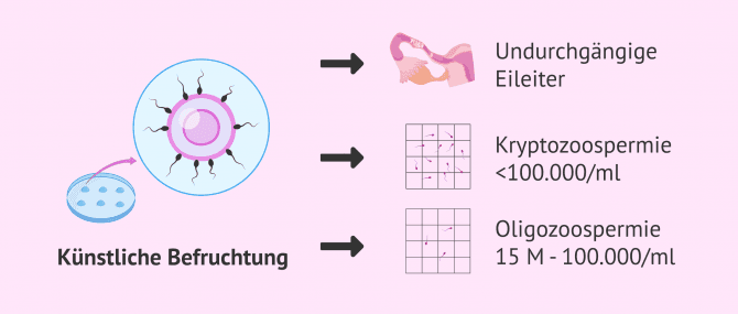 Imagen: IVF als Lösung bei männlicher und weiblicher Fruchtbarkeitsstörungen