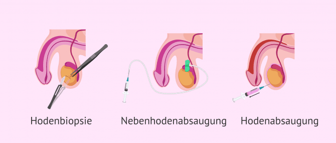 Imagen: Methoden zur Spermiengewinnung