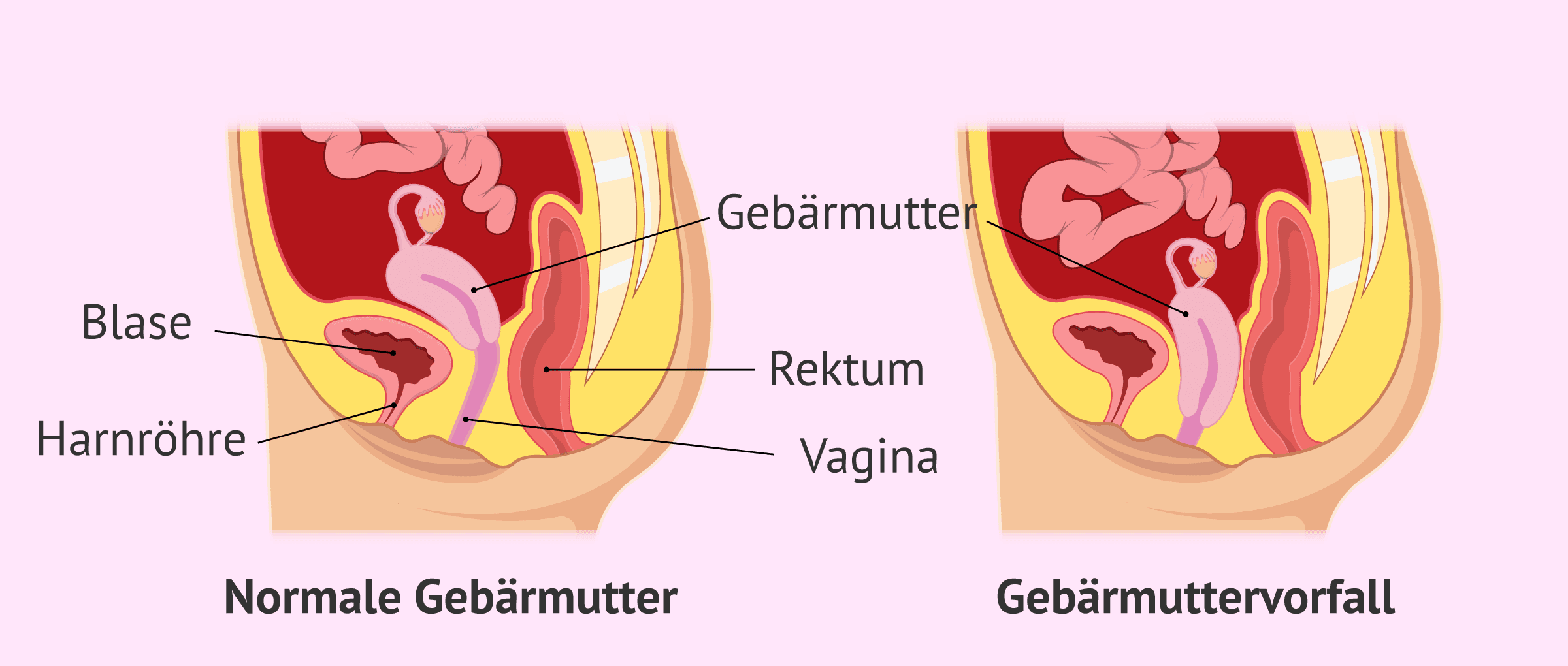 Was ist ein Gebärmuttervorfall? - Ursachen, Symptome und Behandlung