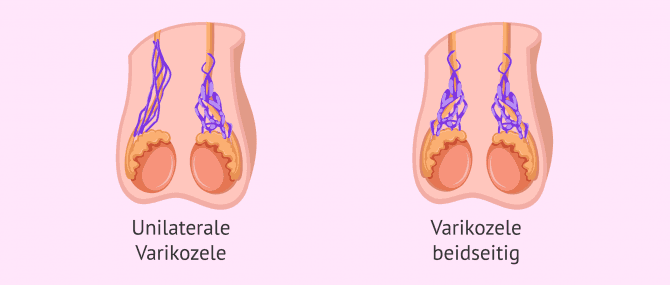 Imagen: Unilaterale und bilaterale Varikozele