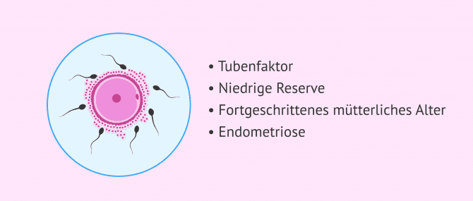 Imagen: In-vitro-Befruchtung (IVF) und weibliche Unfruchtbarkeit