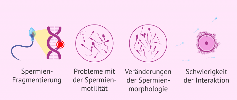 Folgen von oxidativem Stress auf die Spermien