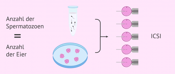 Imagen: ICSI bei Männern mit Kryptozoospermie