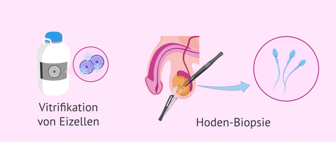 Imagen: Optionen für die Spermagewinnung