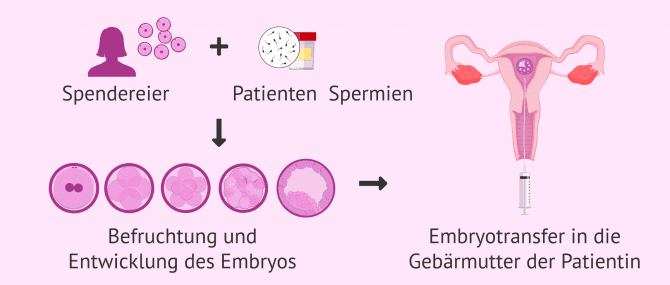 Imagen: Ovodonation und weibliche Unfruchtbarkeit