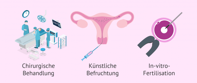 Imagen: Elternschaft mit Varikozele