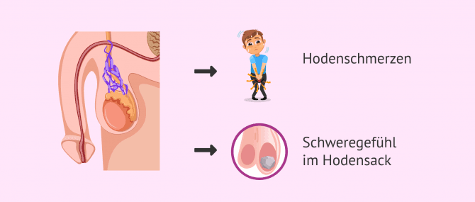 Imagen: Symptome der sekundären Varikozele