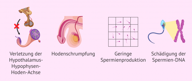 Imagen: Folgen der Varikozele auf die Fruchtbarkeit