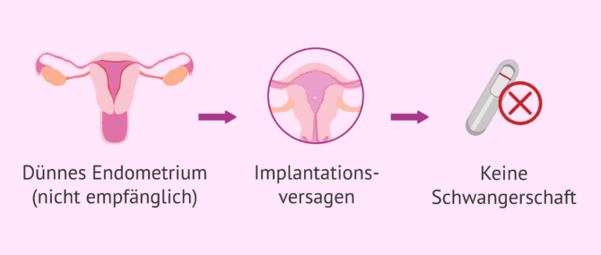 Imagen: Wann ist das endometriale Scratching angezeigt?