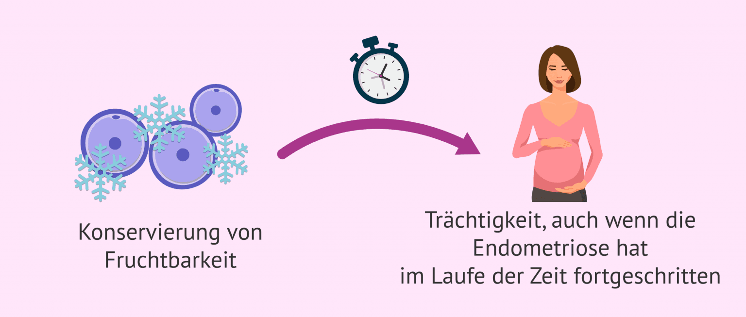 Wie kann ich mit Endometriose schwanger werden?