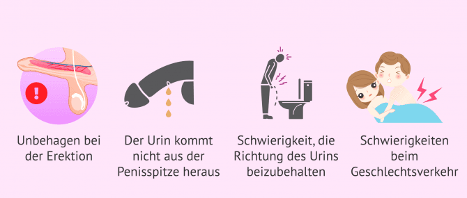 Imagen: Symptome der Hypospadie