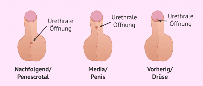 Imagen: Wie kann eine Hypospadie entstehen?