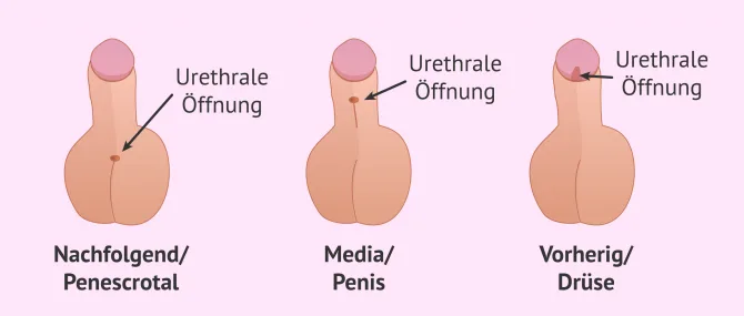 was ist eine penishülle Penis-Probleme und was dahinter steckt main image 1