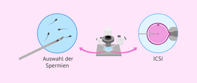 Imagen: Oligoastenoteratozoospermie und assistierte Reproduktion