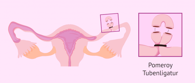 Imagen: Pomeroy-Technik zur Tubenligatur