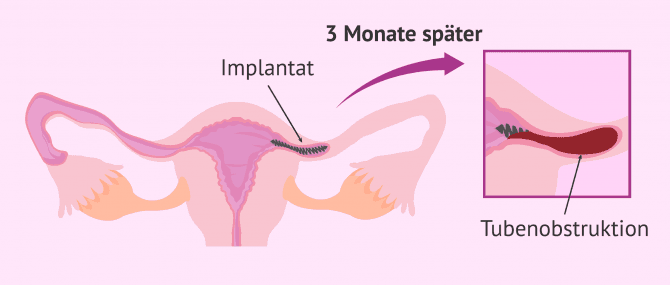 Imagen: Essure-Methode der Eileiterunterbindung