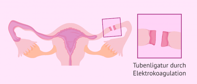 Imagen: Kauterisation und Tubenligatur