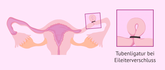 Imagen: Tubenligatur mit Clips oder Klammern