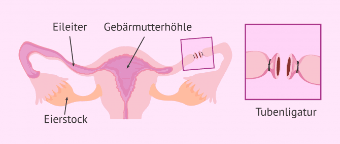 Imagen: Tubenligatur-Operation
