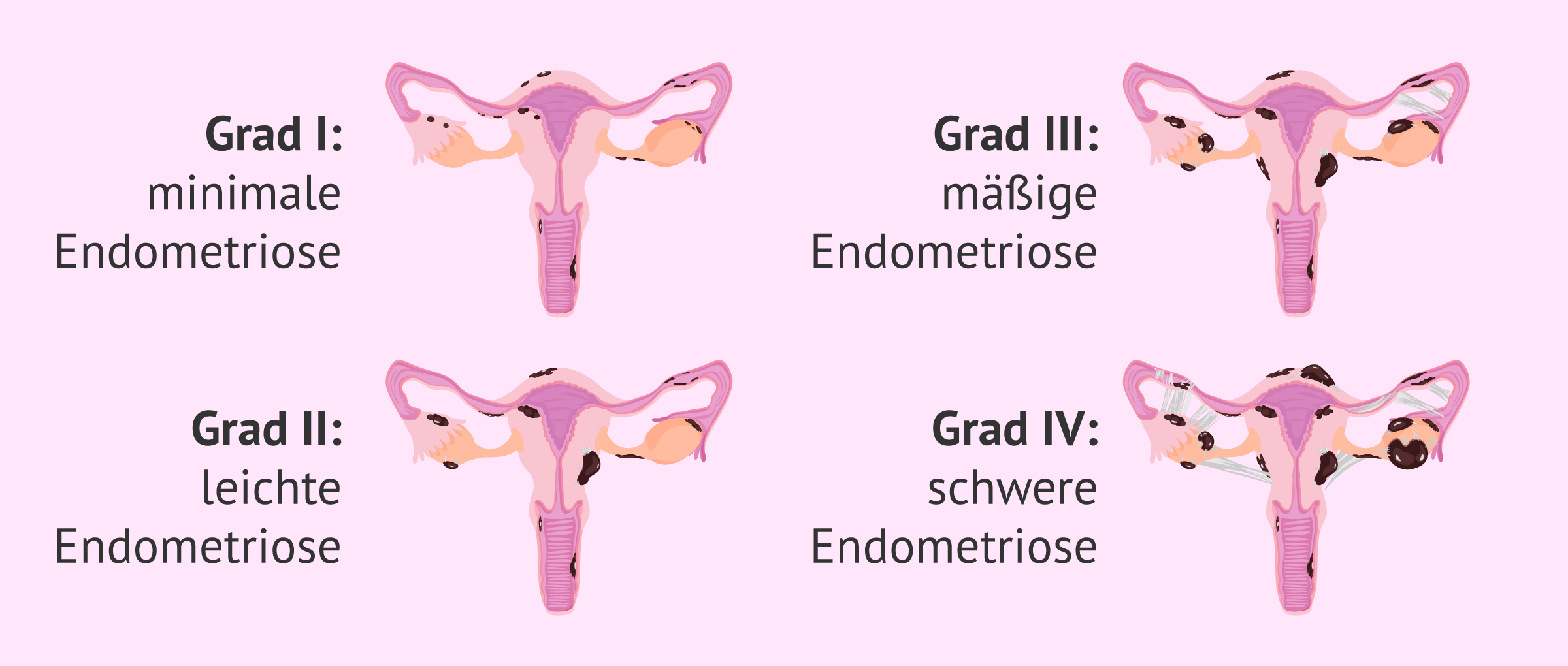 Welche Formen der Endometriose gibt es?