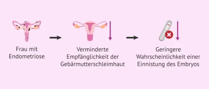Wie wirkt sich die Endometriose auf die Fruchtbarkeit der Frau aus?