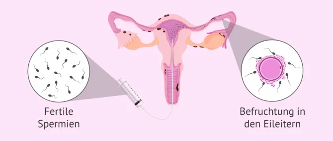 Wie wirkt sich die Endometriose auf die Fruchtbarkeit der Frau aus?