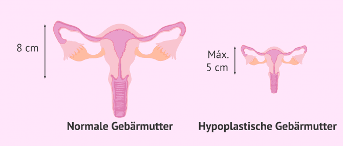 Imagen: Die hypoplastische Gebärmutter