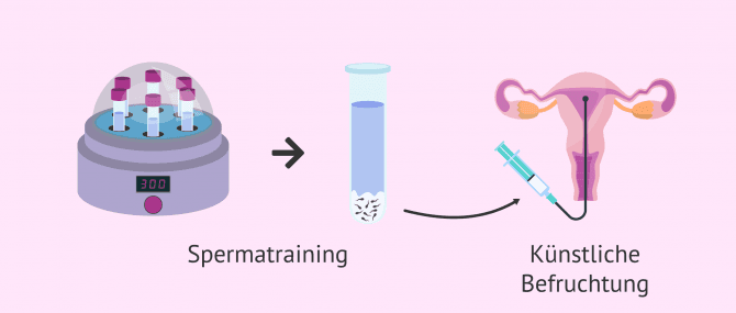 Imagen: Künstliche Befruchtung mit Spermakapazitation