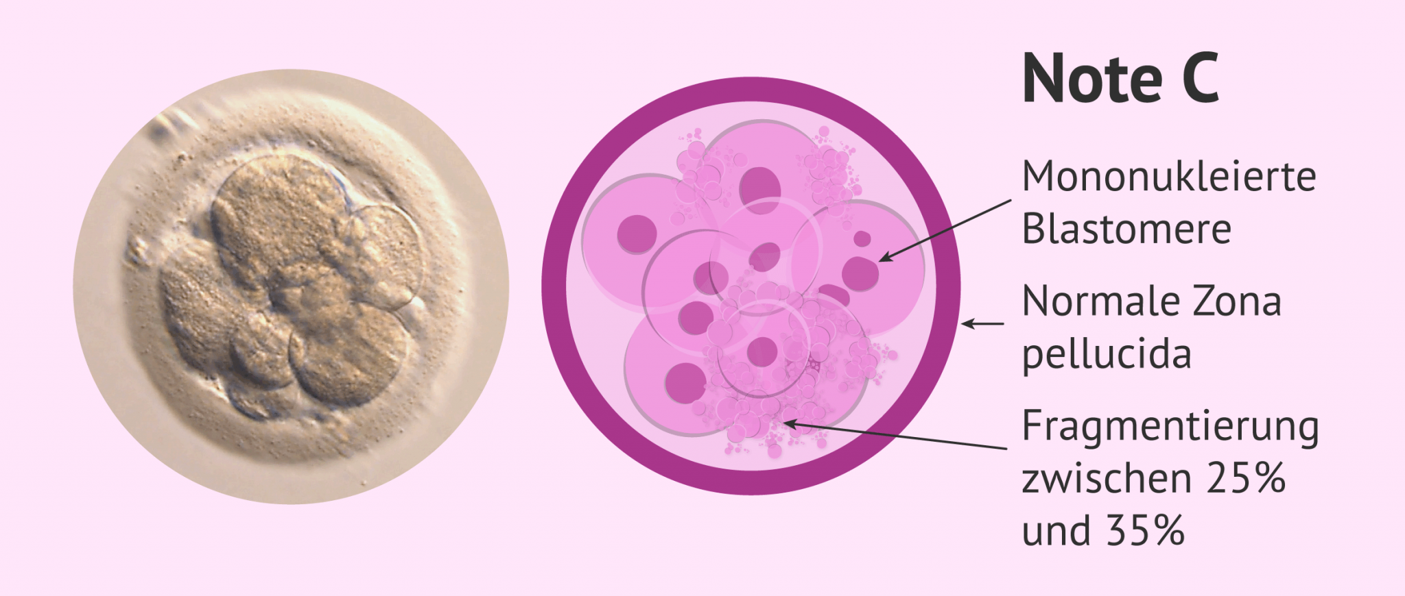 Qualität der Embryonen für den Embryotransfer oder das Einfrieren von ...