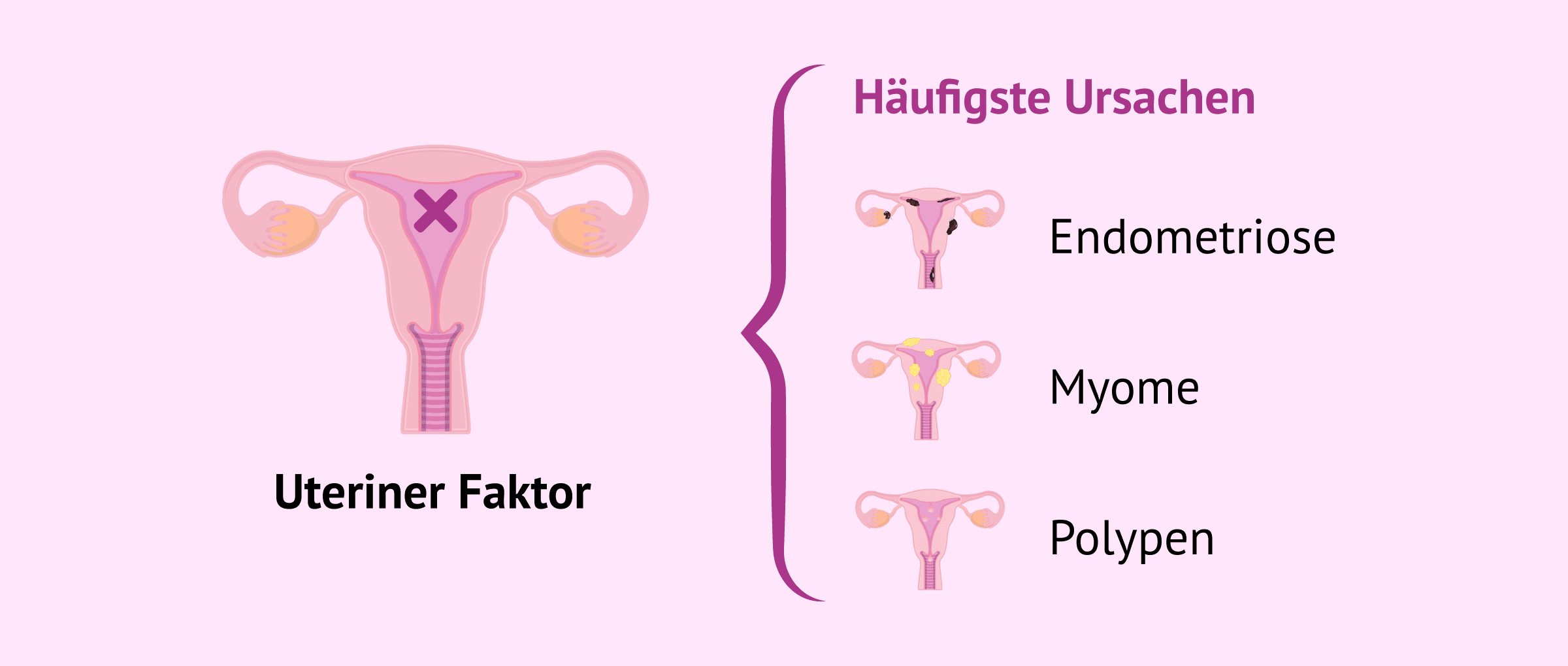Imagen: Hauptursachen der weiblichen Unfruchtbarkeit durch den uterinen Faktor