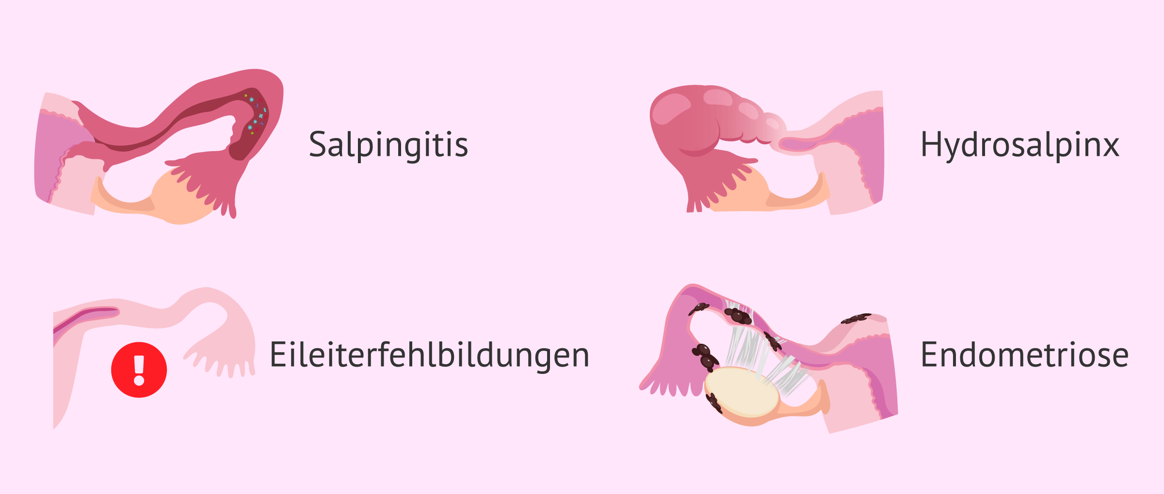 Imagen: Ursachen des Eileiterfaktors bei Frauen