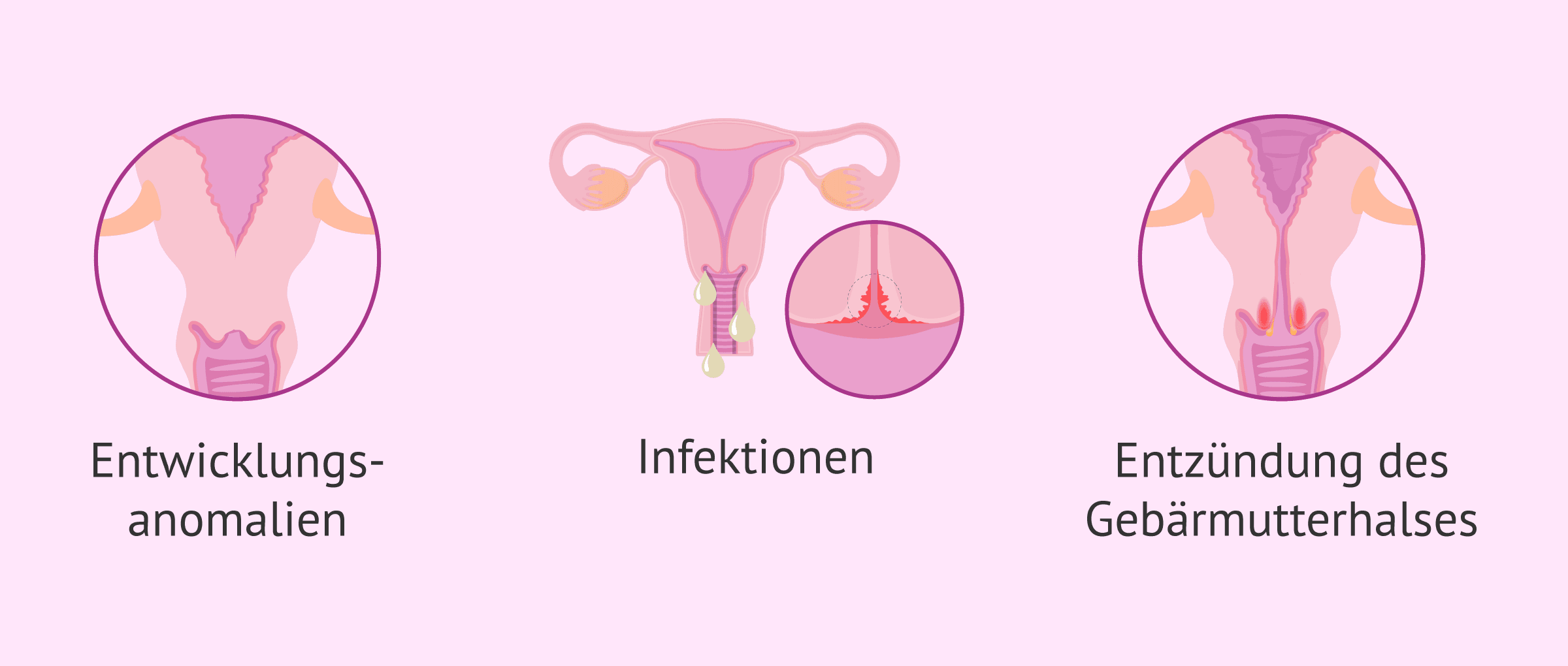 Imagen: Weibliche Unfruchtbarkeit durch zervikalen Faktor