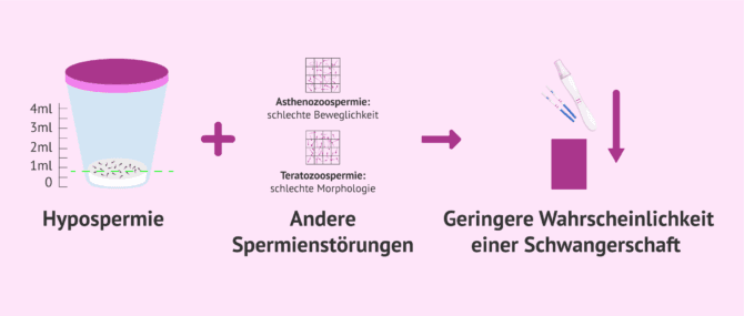 Imagen: Möglichkeit einer Schwangerschaft bei Hypospermie und anderen Samenveränderungen