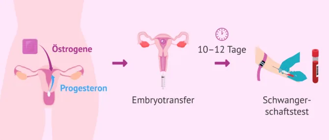 Wie funktioniert eine In-vitro-Fertilisation mit Eizellenspende?